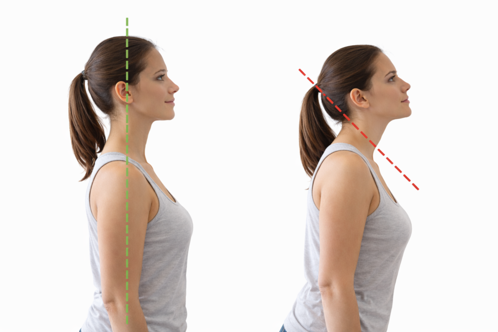 compensacion cervical en extension para evitar que la cabeza caiga hacia delante